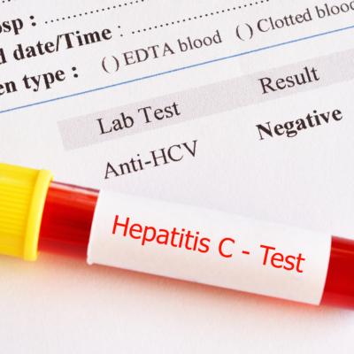 vírus da hepatite C
